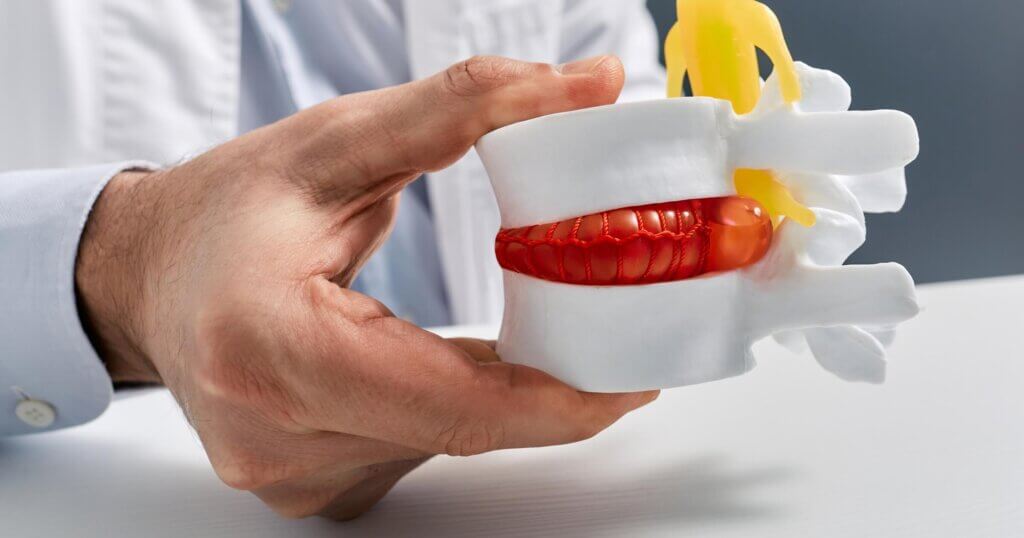 Anatomical lumbar disc herniation model in doctor hand while consultation in medical clinic. Intervertebral hernia treatment.