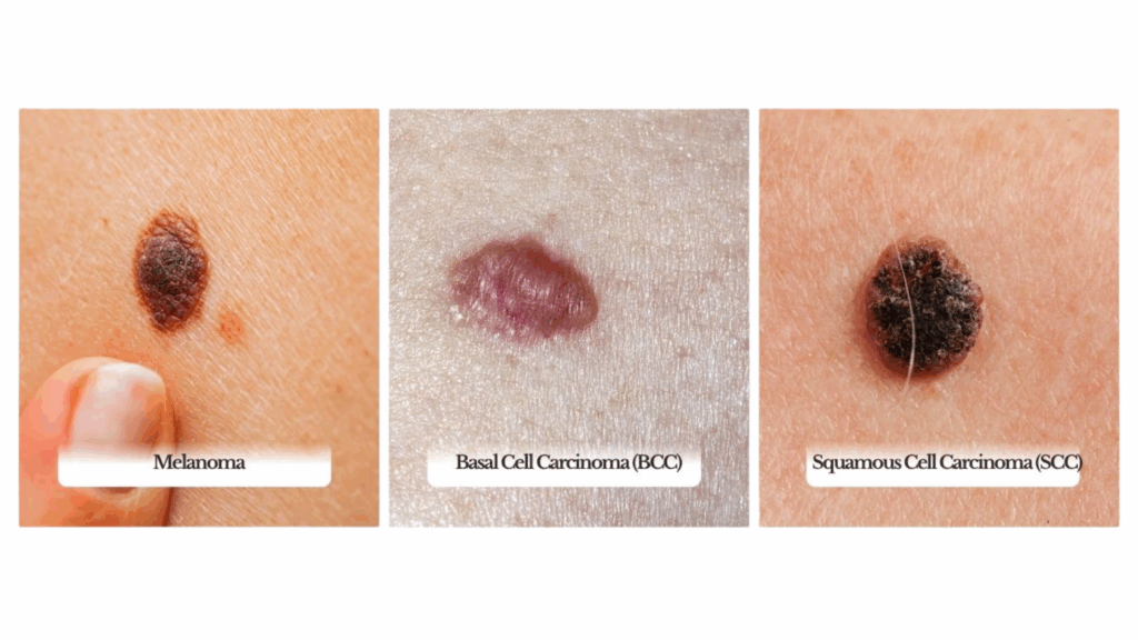 UV on the jobsite: A construction worker’s guide to skin cancer awareness 1 Types of skin cancer and sun damage construction pros should know